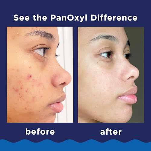 PanOxyl 10% Benzoyl Peroxide Acne Foaming Wash – Maximum Strength Face & Body Cleanser 5.5 oz